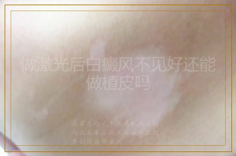 做激光后白癜风不见好还能做植皮吗