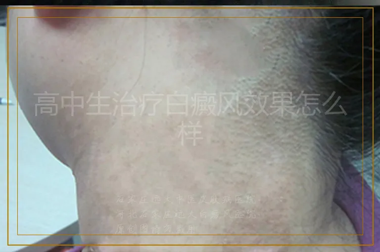 高中生治疗白癜风效果怎么样