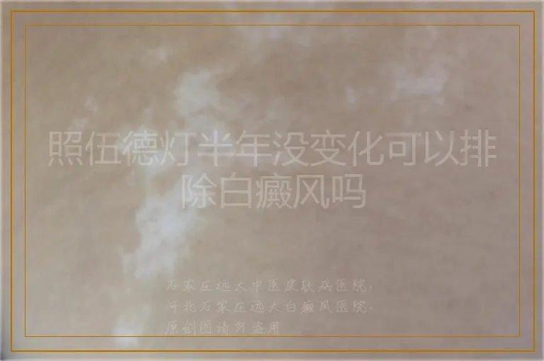 照伍德灯半年没变化可以排除白癜风吗