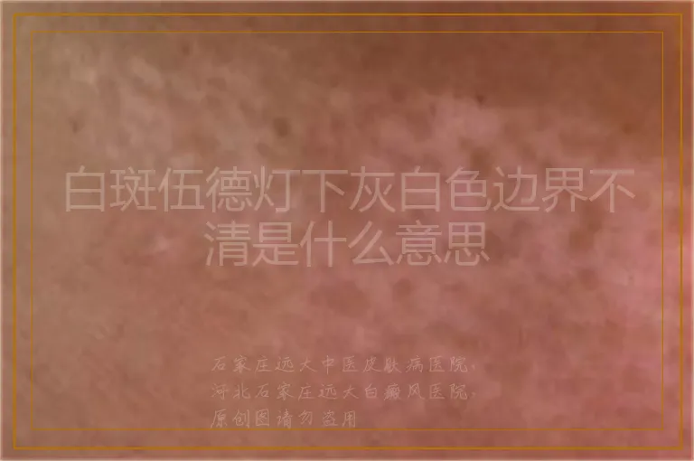白斑伍德灯下灰白色边界不清是什么意思