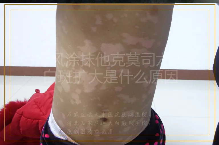 白癜风涂抹他克莫司六天后白斑扩大是什么原因