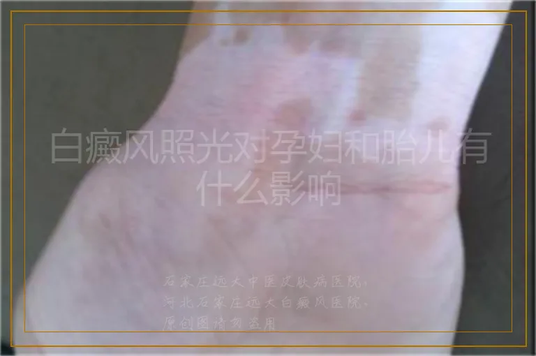 白癜风照光对孕妇和胎儿有什么影响