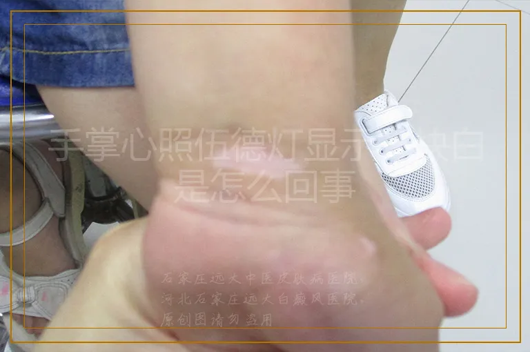 手掌心照伍德灯显示一块白是怎么回事