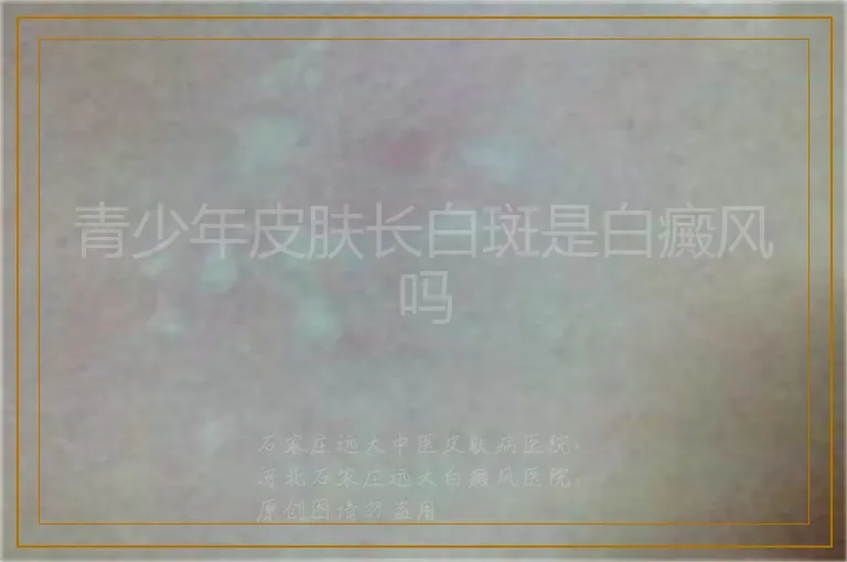 青少年皮肤长白斑是白癜风吗