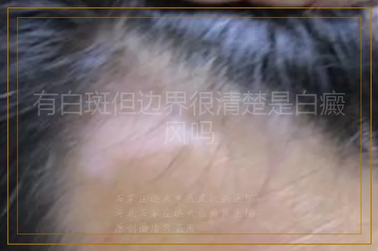 有白斑但边界很清楚是白癜风吗