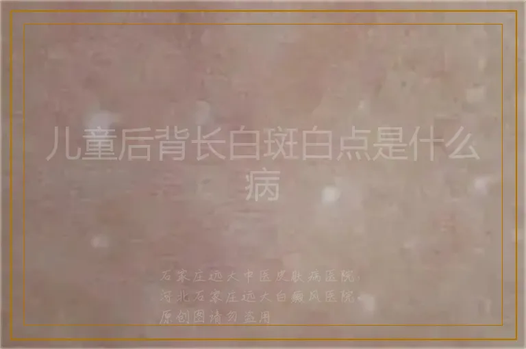儿童后背长白斑白点是什么病