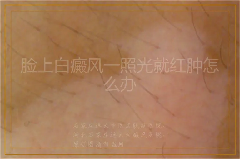 脸上白癜风一照光就红肿怎么办