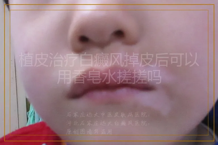 植皮治疗白癜风掉皮后可以用香皂水搓搓吗