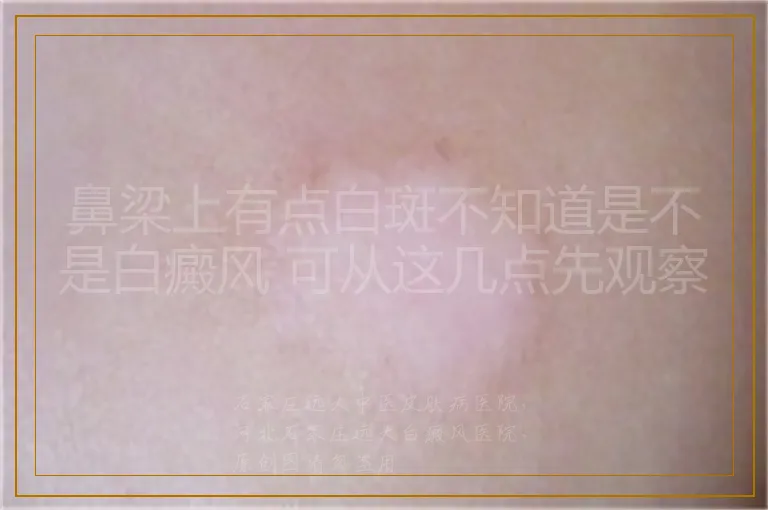 鼻梁上有点白斑不知道是不是白癜风 可从这几点先观察