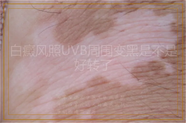 白癜风照UVB周围变黑是不是好转了