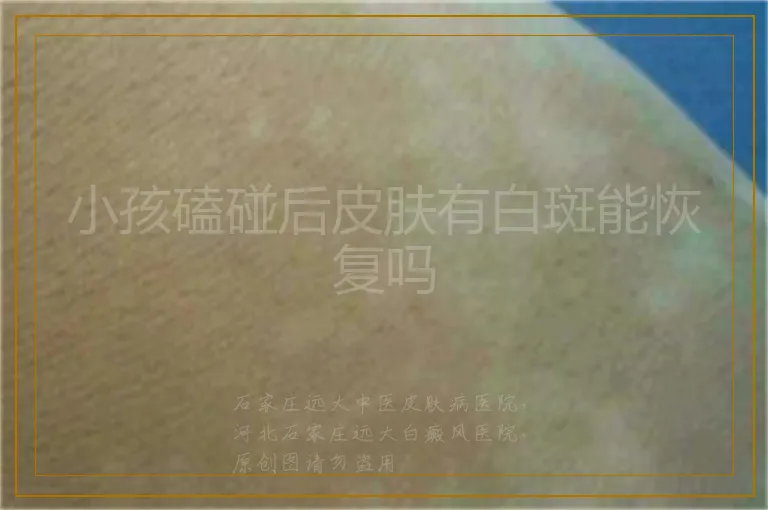 小孩磕碰后皮肤有白斑能恢复吗