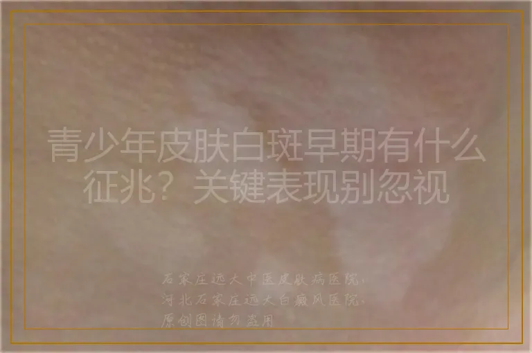 青少年皮肤白斑早期有什么征兆？关键表现别忽视
