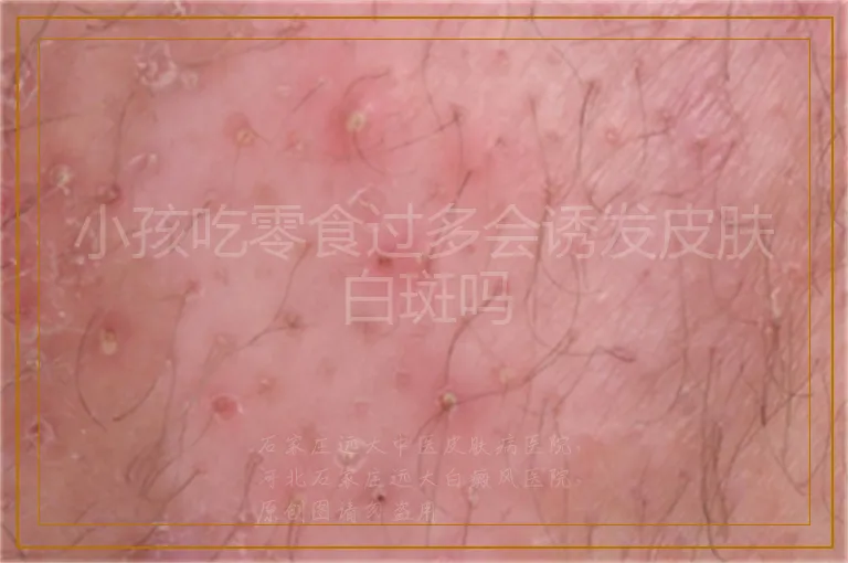 小孩吃零食过多会诱发皮肤白斑吗
