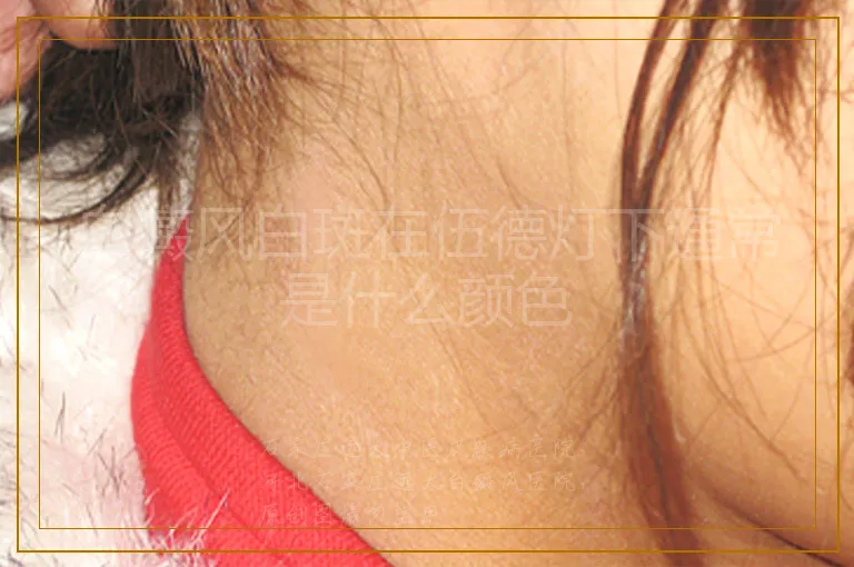 白癜风白斑在伍德灯下通常是什么颜色