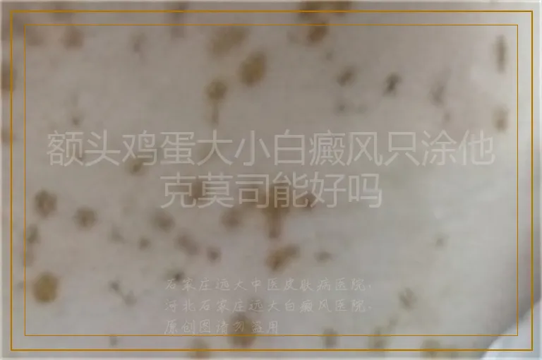 额头鸡蛋大小白癜风只涂他克莫司能好吗