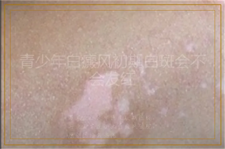 青少年白癜风初期白斑会不会发红