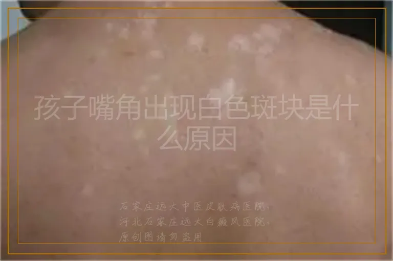 孩子嘴角出现白色斑块是什么原因
