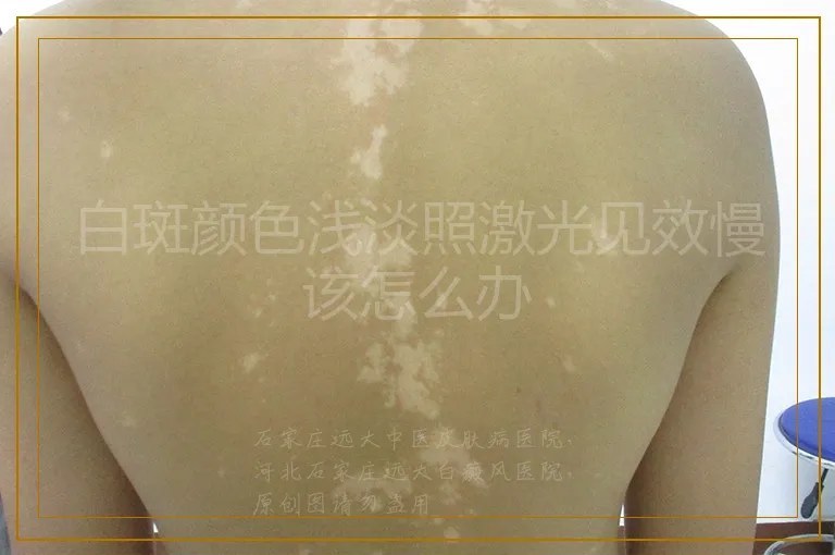 白斑颜色浅淡照激光见效慢该怎么办