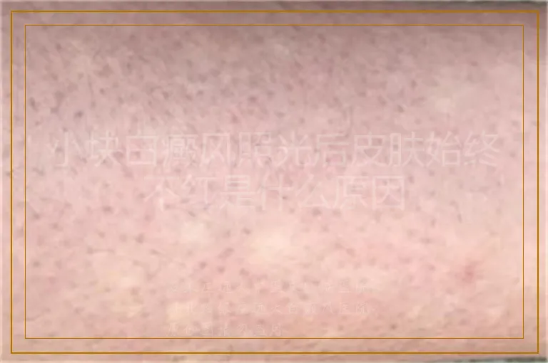 小块白癜风照光后皮肤始终不红是什么原因