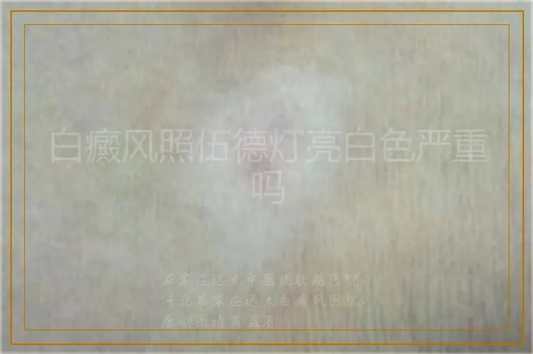 白癜风照伍德灯亮白色严重吗