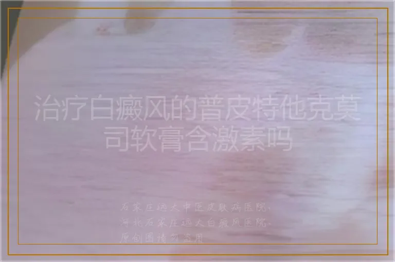 治疗白癜风的普皮特他克莫司软膏含激素吗