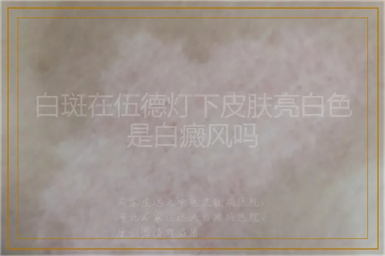 白斑在伍德灯下皮肤亮白色是白癜风吗