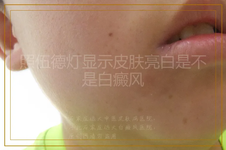 照伍德灯显示皮肤亮白是不是白癜风