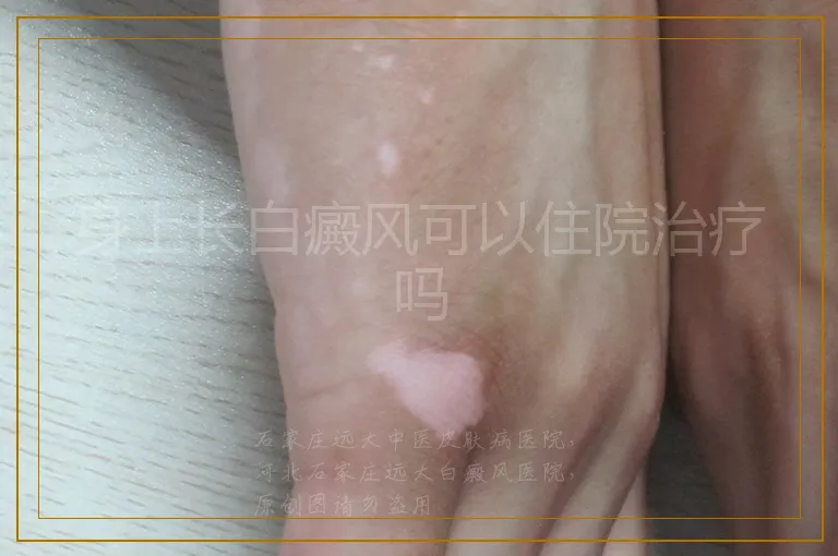 身上长白癜风可以住院治疗吗