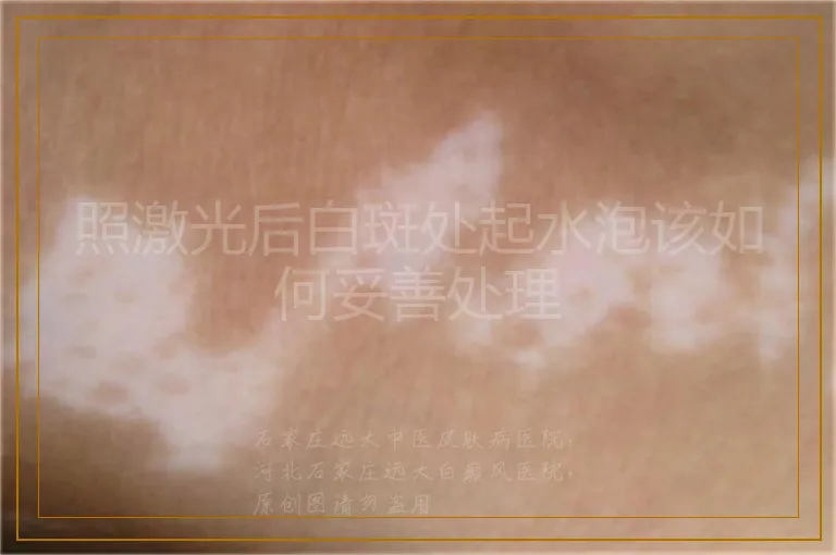 照激光后白斑处起水泡该如何妥善处理