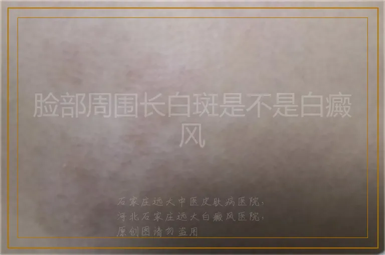 脸部周围长白斑是不是白癜风