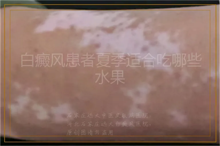 白癜风患者夏季适合吃哪些水果