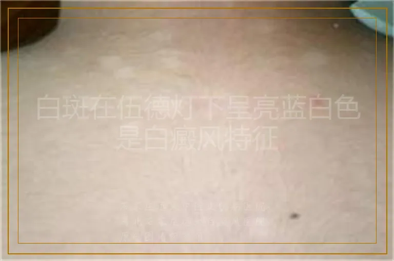 白斑在伍德灯下呈亮蓝白色是白癜风特征