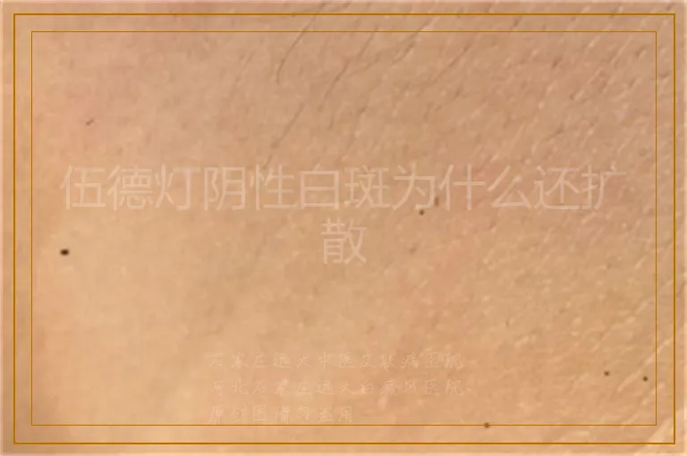伍德灯阴性白斑为什么还扩散