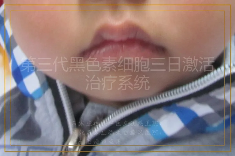 第三代黑色素细胞三日激活治疗系统