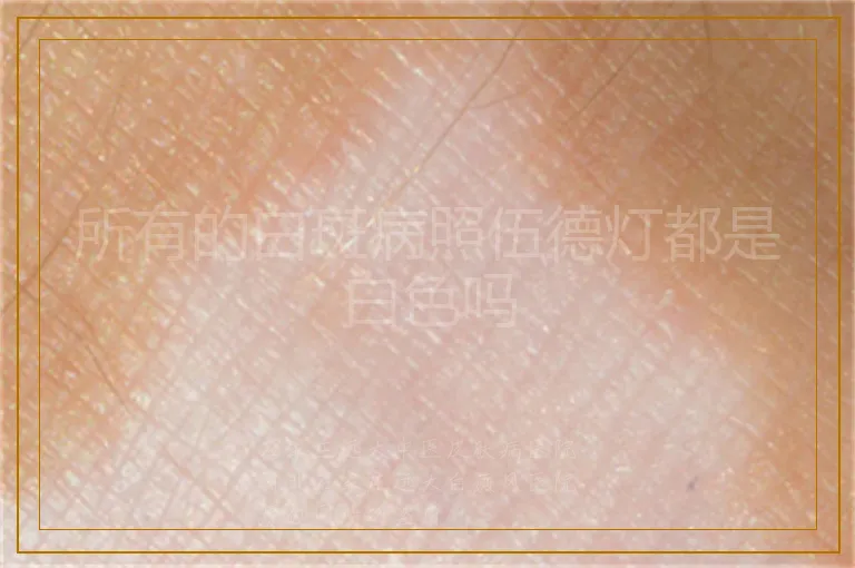 所有的白斑病照伍德灯都是白色吗