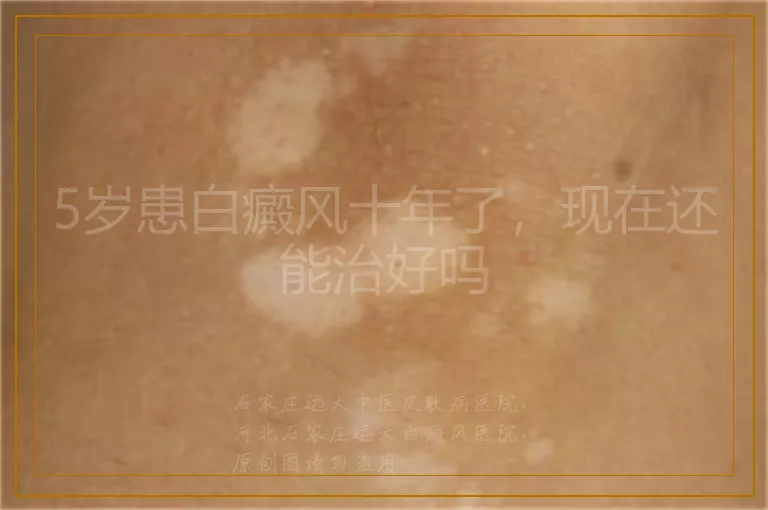 5岁患白癜风十年了,现在还能治好吗
