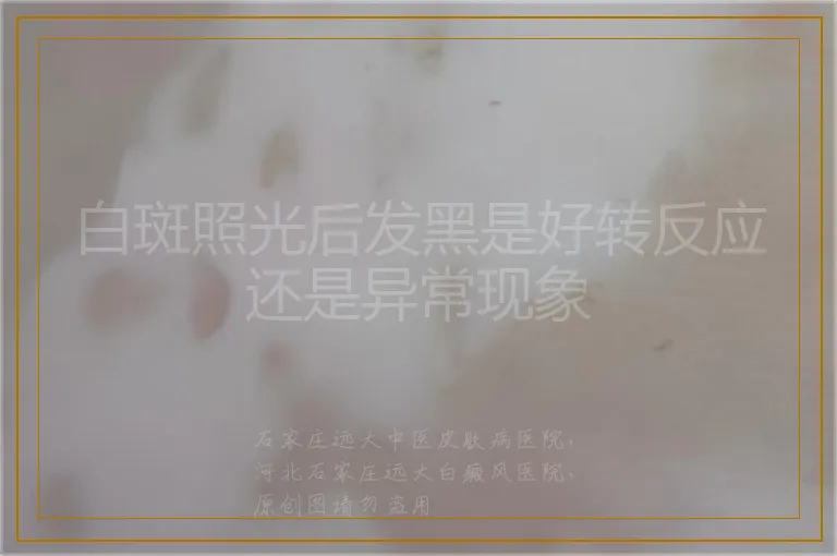 白斑照光后发黑是好转反应还是异常现象
