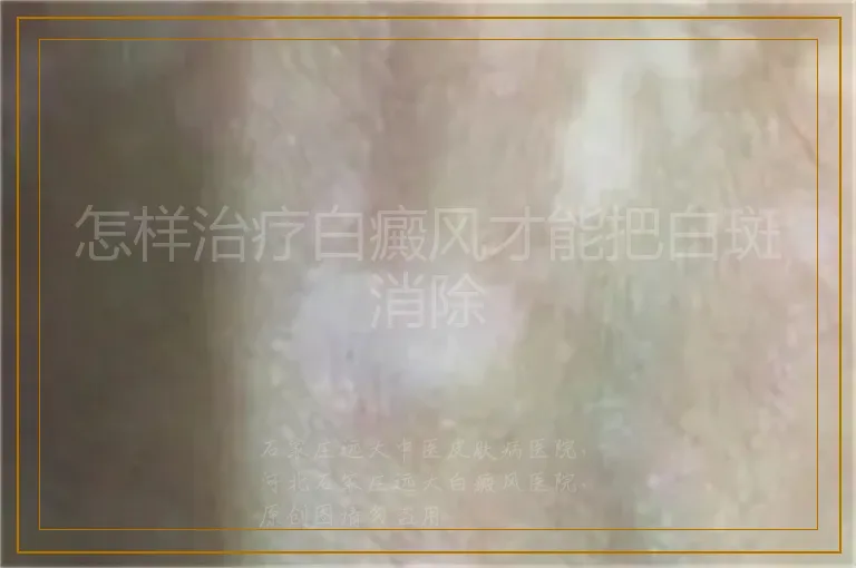 怎样治疗白癜风才能把白斑消除