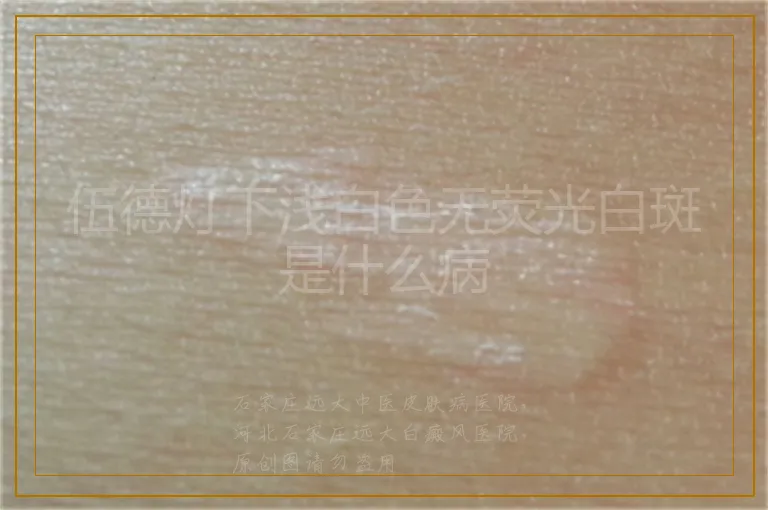 伍德灯下浅白色无荧光白斑是什么病