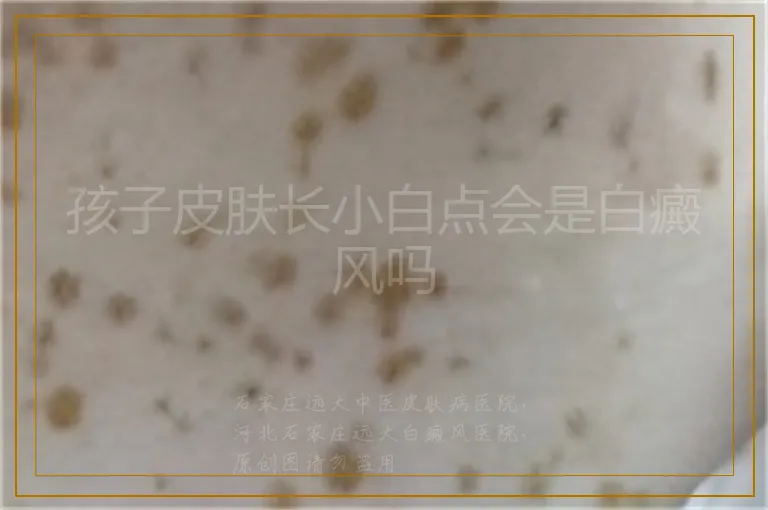 孩子皮肤长小白点会是白癜风吗