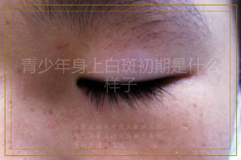 青少年身上白斑初期是什么样子