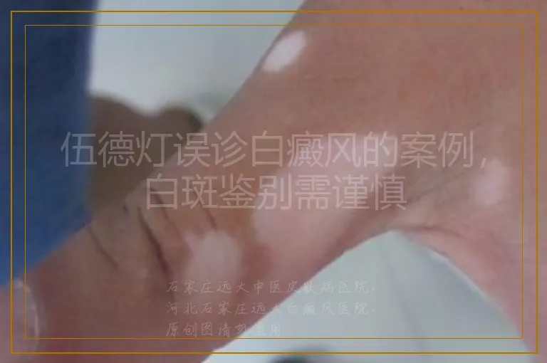 伍德灯误诊白癜风的案例，白斑鉴别需谨慎