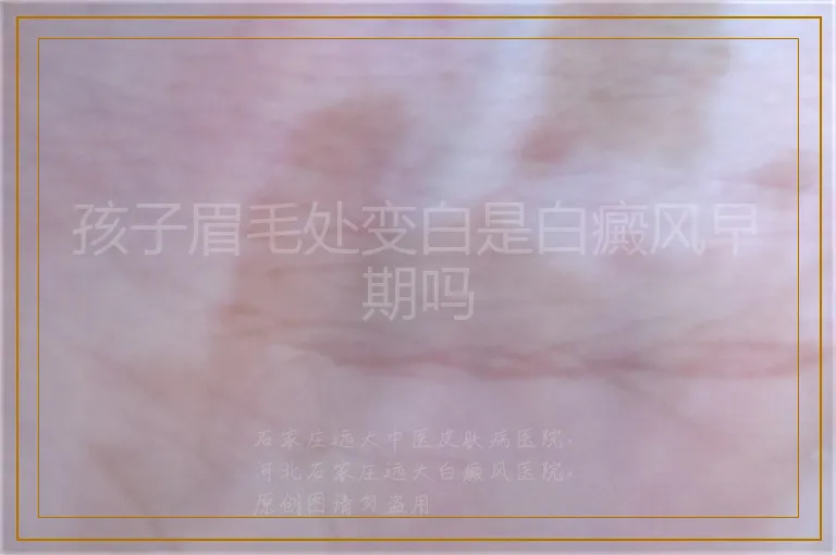 孩子眉毛处变白是白癜风早期吗