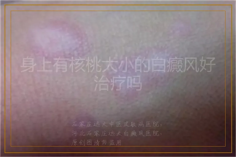 身上有核桃大小的白癜风好治疗吗