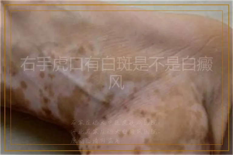 右手虎口有白斑是不是白癜风