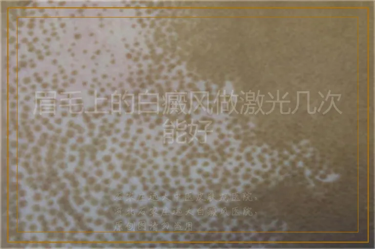 眉毛上的白癜风做激光几次能好