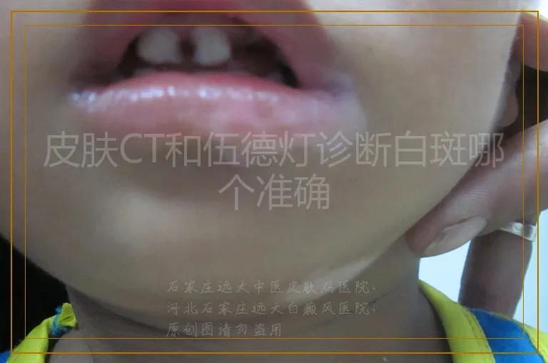皮肤CT和伍德灯诊断白斑哪个准确