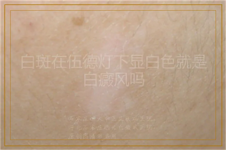 白斑在伍德灯下显白色就是白癜风吗