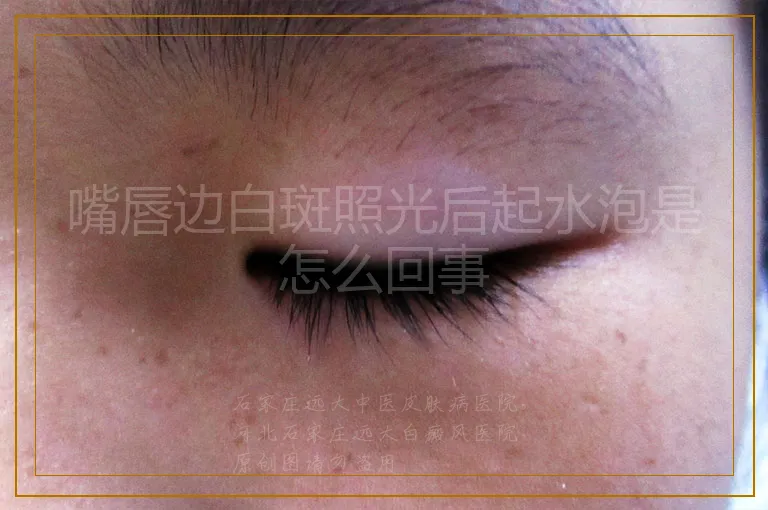 嘴唇边白斑照光后起水泡是怎么回事