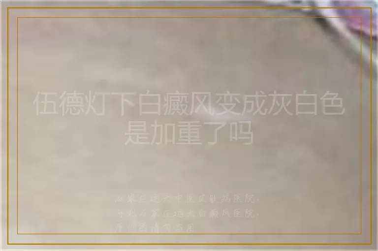伍德灯下白癜风变成灰白色是加重了吗